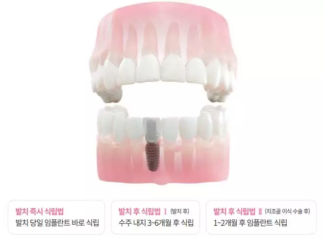 전악 임플란트 - 출처 디오 임플란트