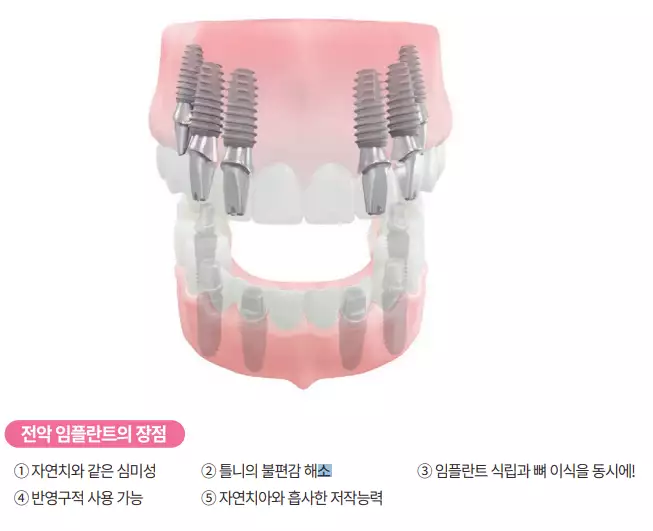 뼈 이식을 동반한 임플란트 - 출처 디오 임플란트