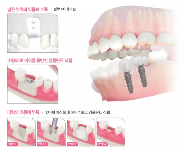 상악동 거상을 동반하는 임플란트 - 출처 디오 임플란트